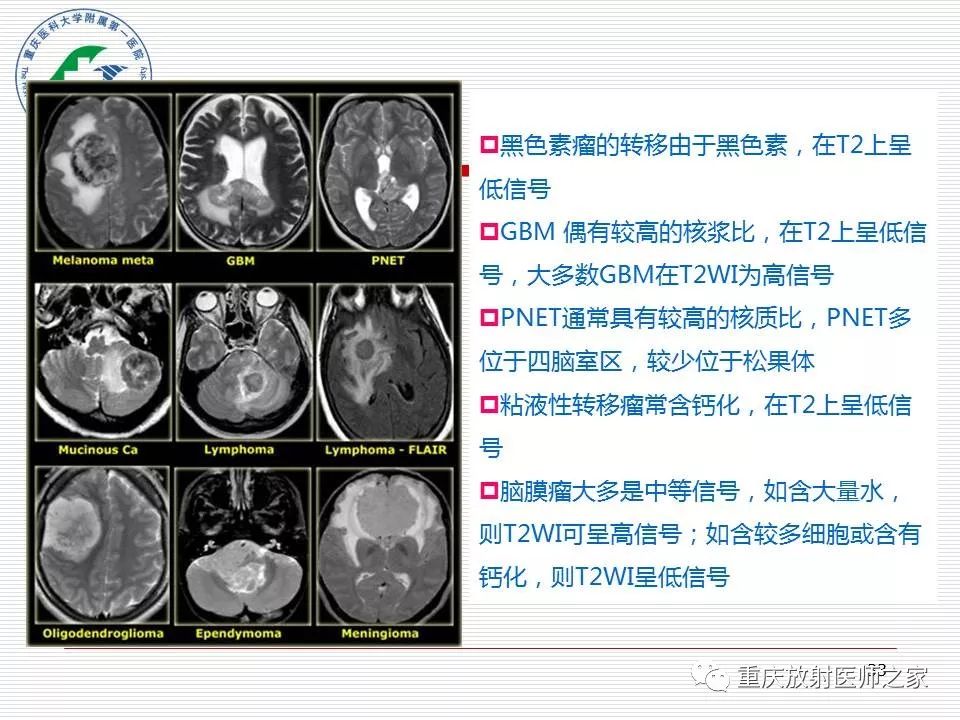 影像PPT - 【PPT】中枢神经系统肿瘤影像学诊断思路-33