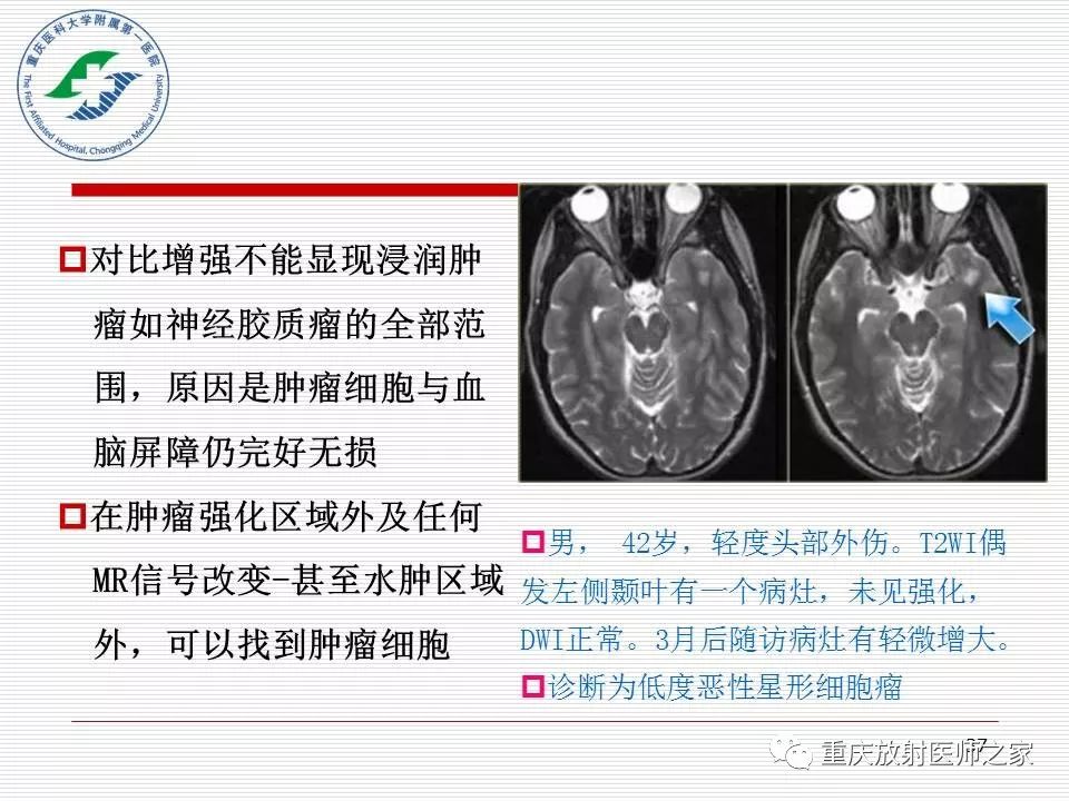影像PPT - 【PPT】中枢神经系统肿瘤影像学诊断思路-37