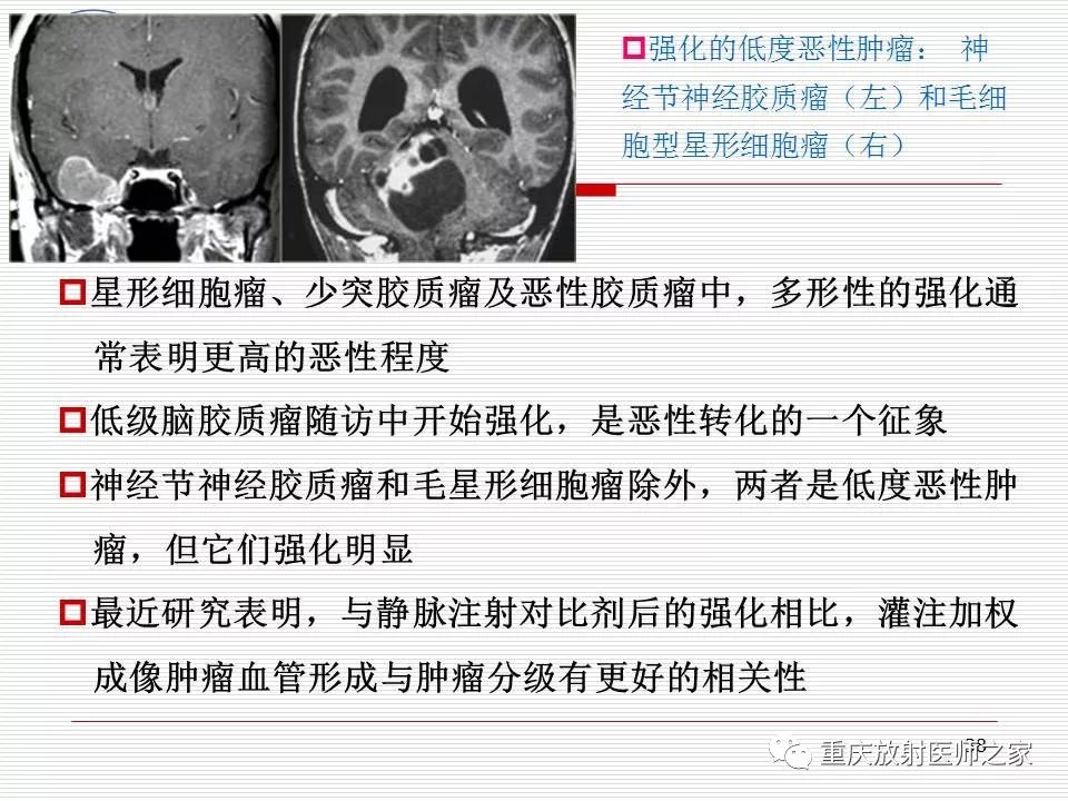 影像PPT - 【PPT】中枢神经系统肿瘤影像学诊断思路-38