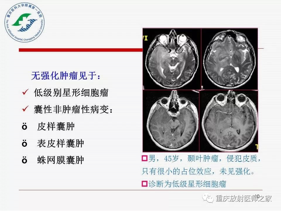 影像PPT - 【PPT】中枢神经系统肿瘤影像学诊断思路-40