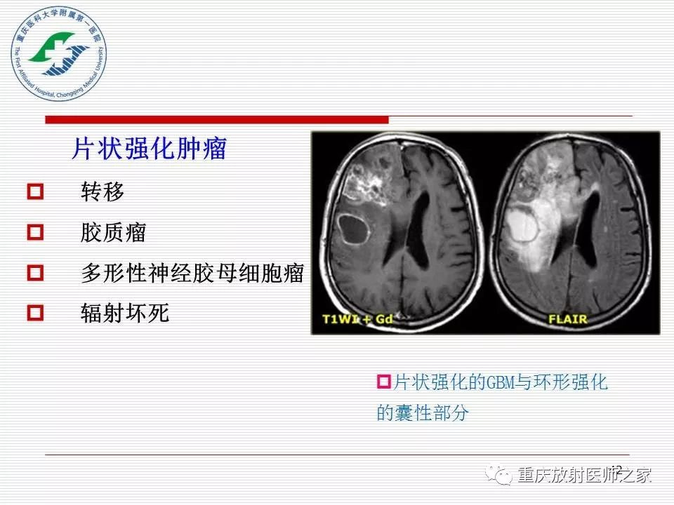 影像PPT - 【PPT】中枢神经系统肿瘤影像学诊断思路-42