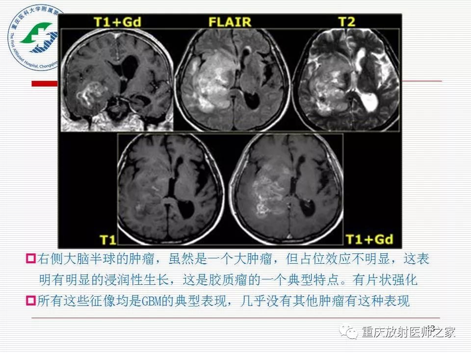 影像PPT - 【PPT】中枢神经系统肿瘤影像学诊断思路-43