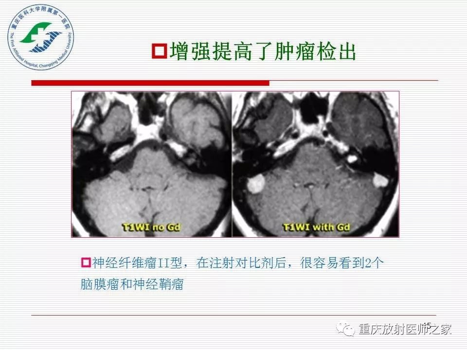 影像PPT - 【PPT】中枢神经系统肿瘤影像学诊断思路-45