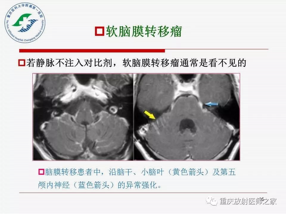 影像PPT - 【PPT】中枢神经系统肿瘤影像学诊断思路-46