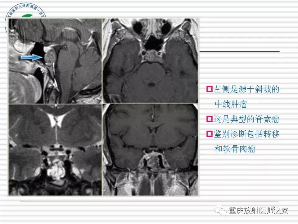 影像PPT - 【PPT】中枢神经系统肿瘤影像学诊断思路-48