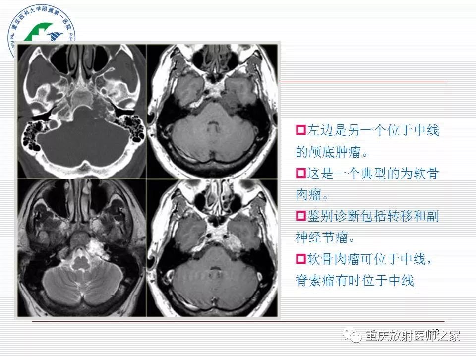 影像PPT - 【PPT】中枢神经系统肿瘤影像学诊断思路-49