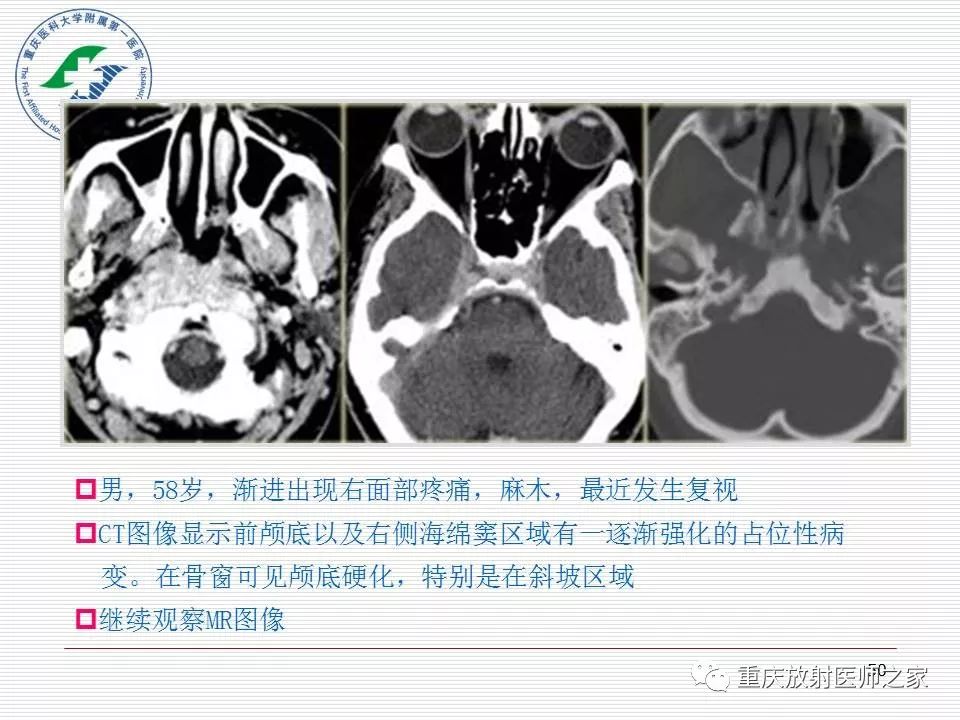影像PPT - 【PPT】中枢神经系统肿瘤影像学诊断思路-50