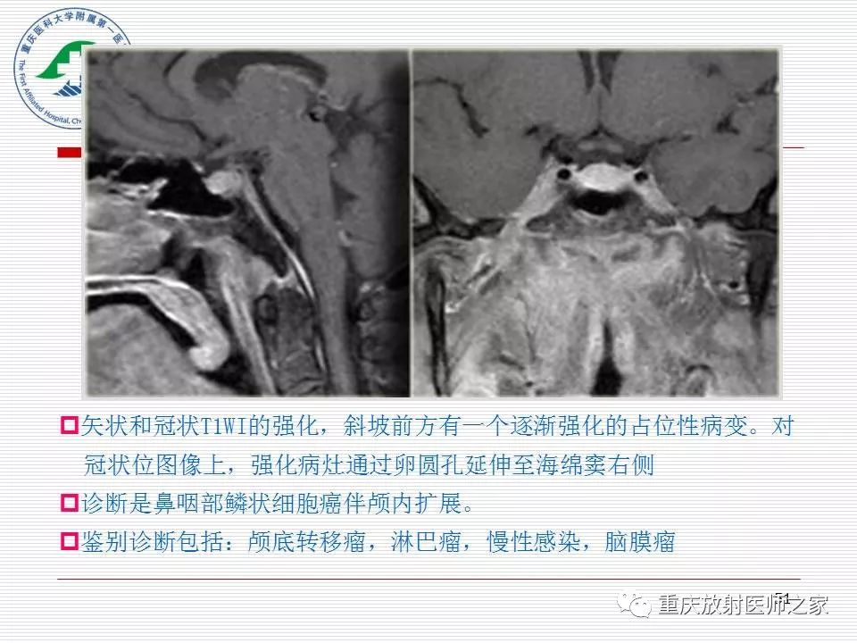 影像PPT - 【PPT】中枢神经系统肿瘤影像学诊断思路-51
