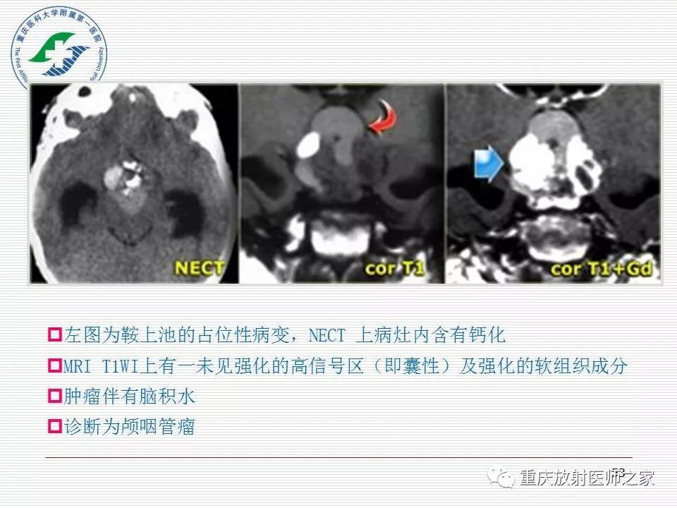 影像PPT - 【PPT】中枢神经系统肿瘤影像学诊断思路-53