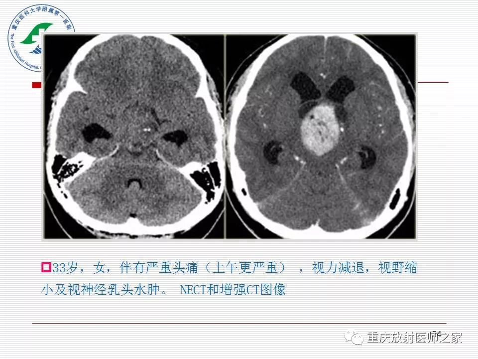 影像PPT - 【PPT】中枢神经系统肿瘤影像学诊断思路-54