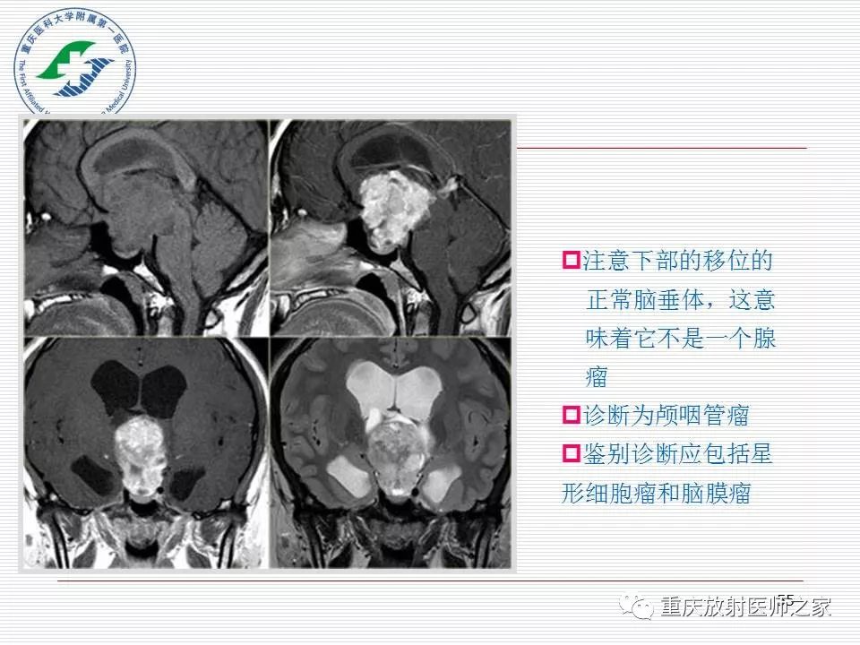 影像PPT - 【PPT】中枢神经系统肿瘤影像学诊断思路-55