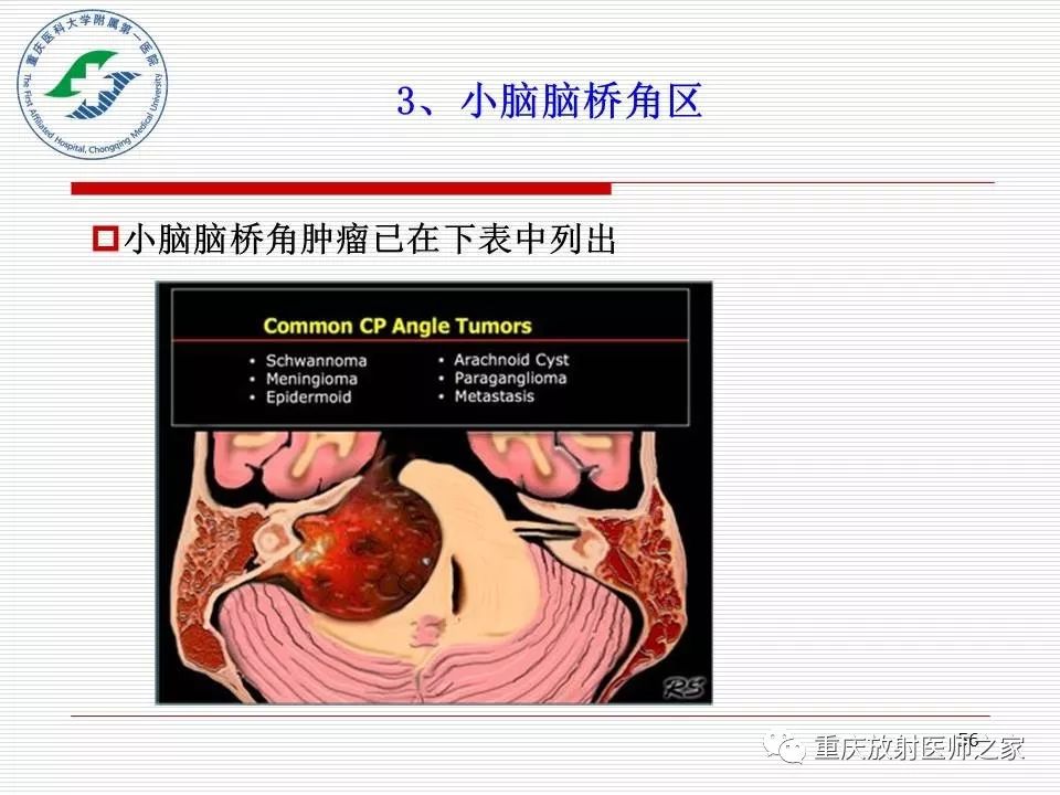 影像PPT - 【PPT】中枢神经系统肿瘤影像学诊断思路-56