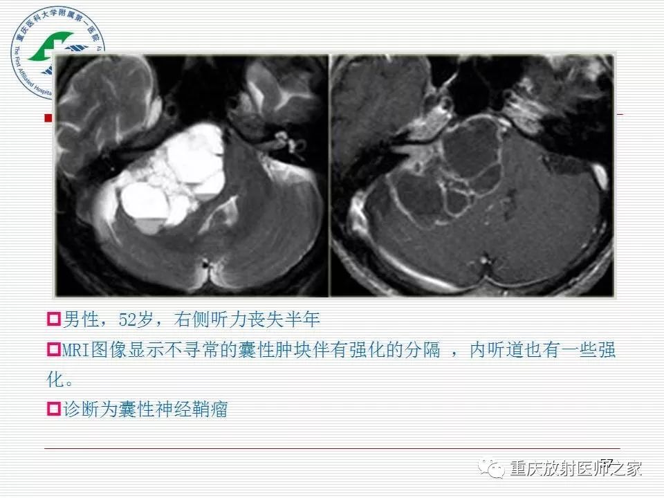 影像PPT - 【PPT】中枢神经系统肿瘤影像学诊断思路-57