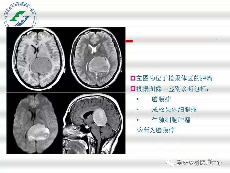 影像PPT - 【PPT】中枢神经系统肿瘤影像学诊断思路-59
