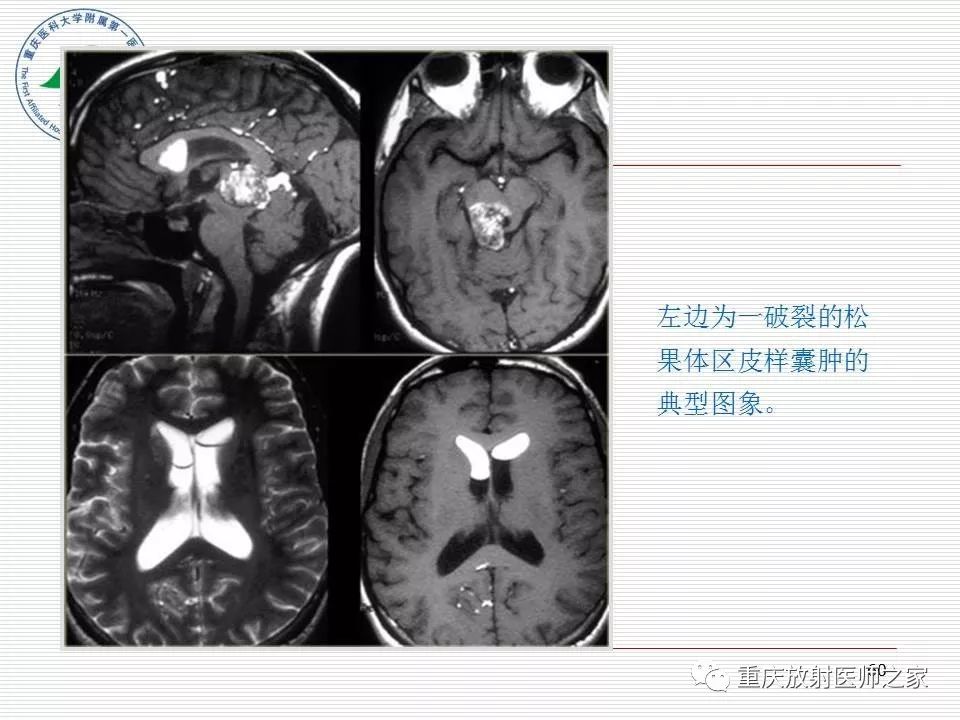 影像PPT - 【PPT】中枢神经系统肿瘤影像学诊断思路-60