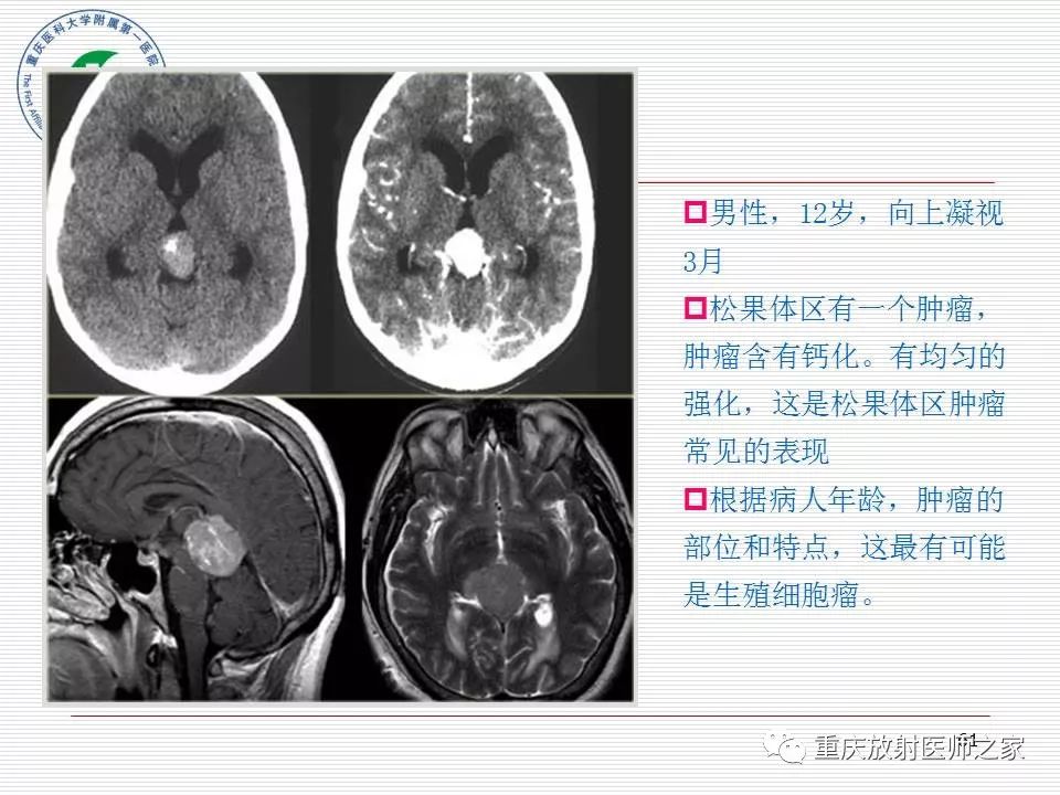 影像PPT - 【PPT】中枢神经系统肿瘤影像学诊断思路-61
