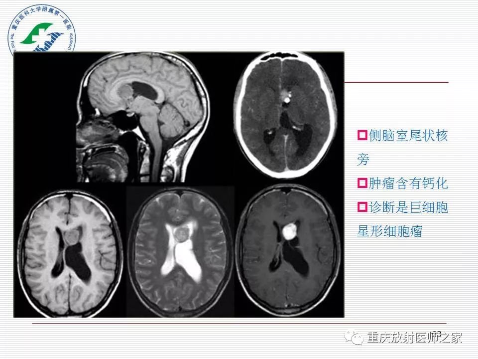 影像PPT - 【PPT】中枢神经系统肿瘤影像学诊断思路-63