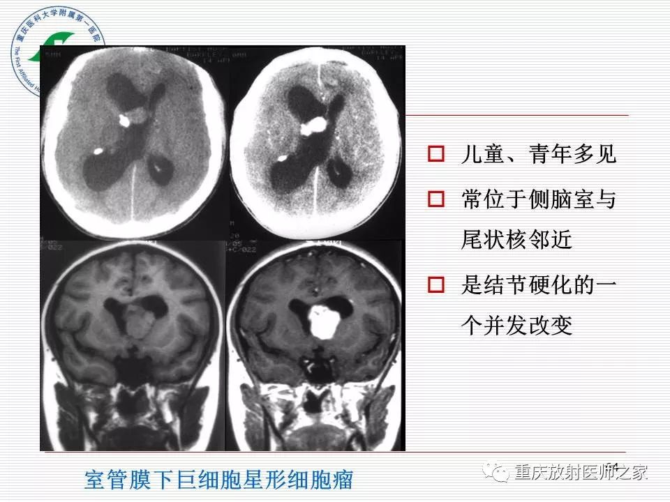 影像PPT - 【PPT】中枢神经系统肿瘤影像学诊断思路-64