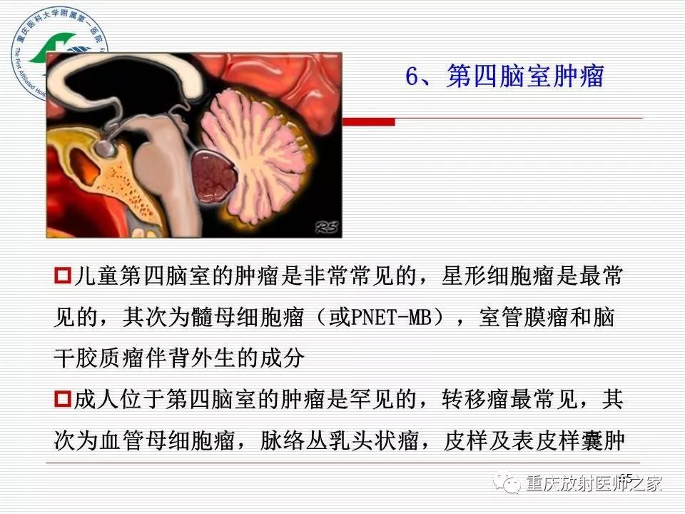 影像PPT - 【PPT】中枢神经系统肿瘤影像学诊断思路-65