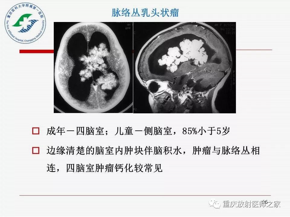 影像PPT - 【PPT】中枢神经系统肿瘤影像学诊断思路-66