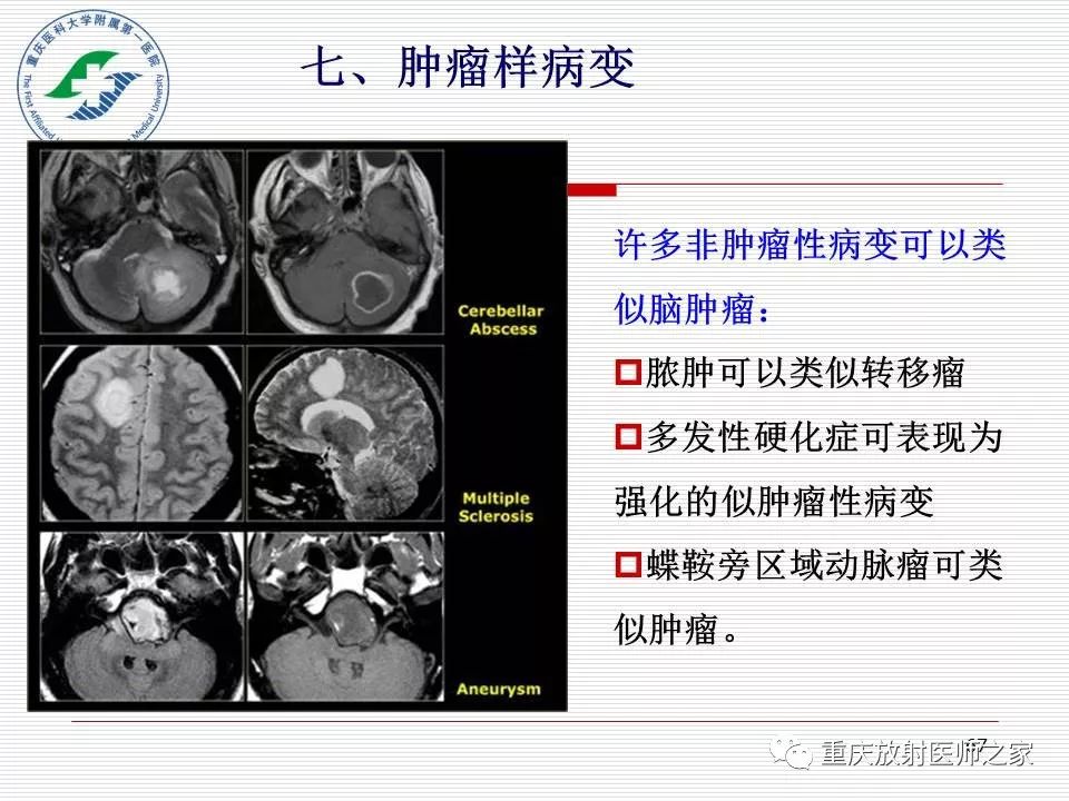 影像PPT - 【PPT】中枢神经系统肿瘤影像学诊断思路-67