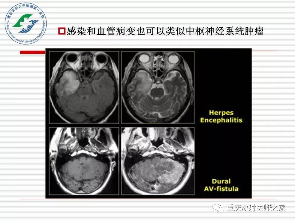 影像PPT - 【PPT】中枢神经系统肿瘤影像学诊断思路-68