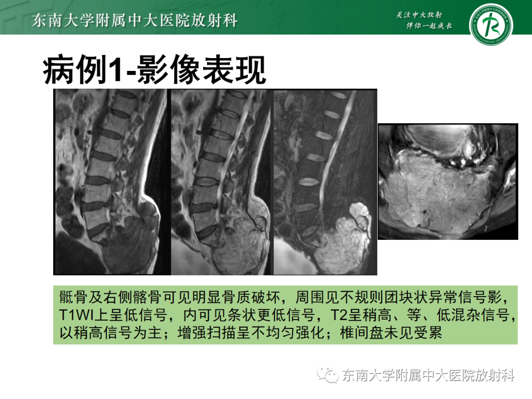 影像PPT - 【PPT】骶尾部脊索瘤-5