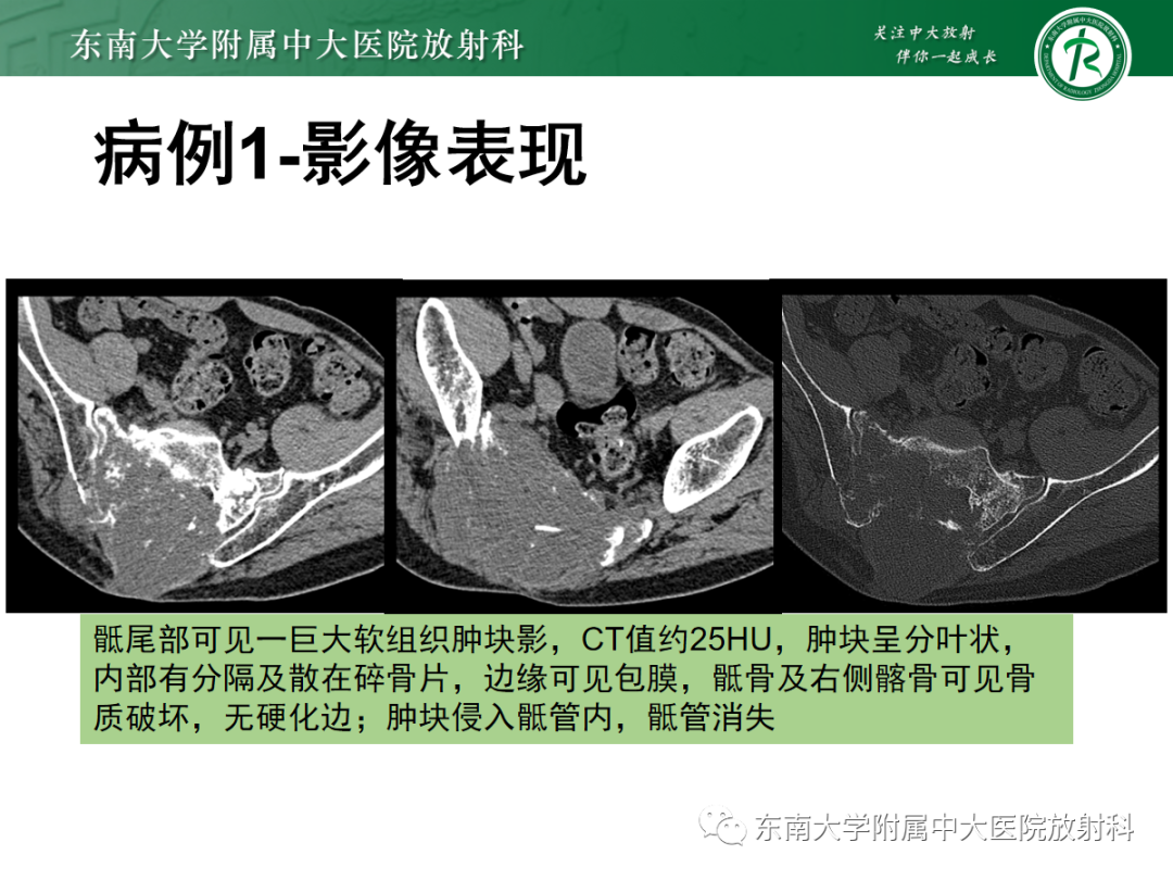 影像PPT - 【PPT】骶尾部脊索瘤-4