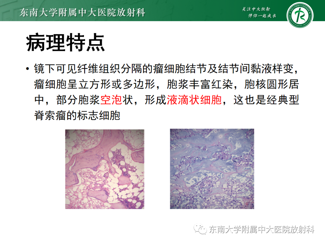 影像PPT - 【PPT】骶尾部脊索瘤-11