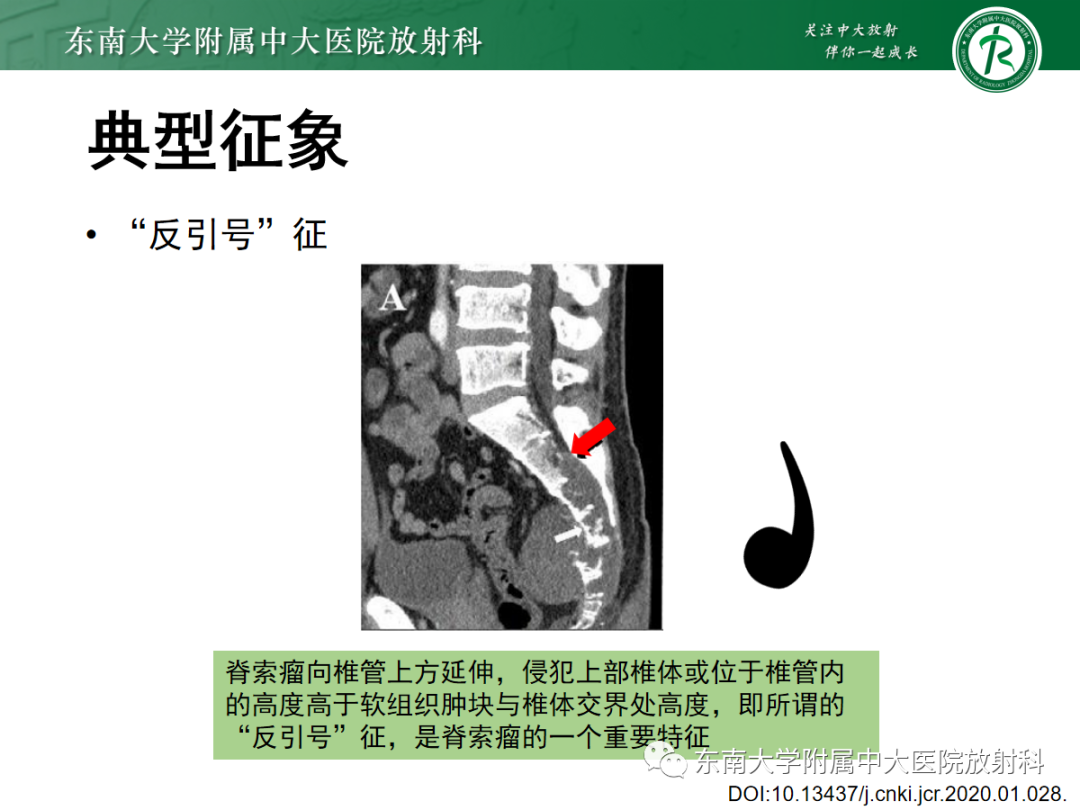 影像PPT - 【PPT】骶尾部脊索瘤-15