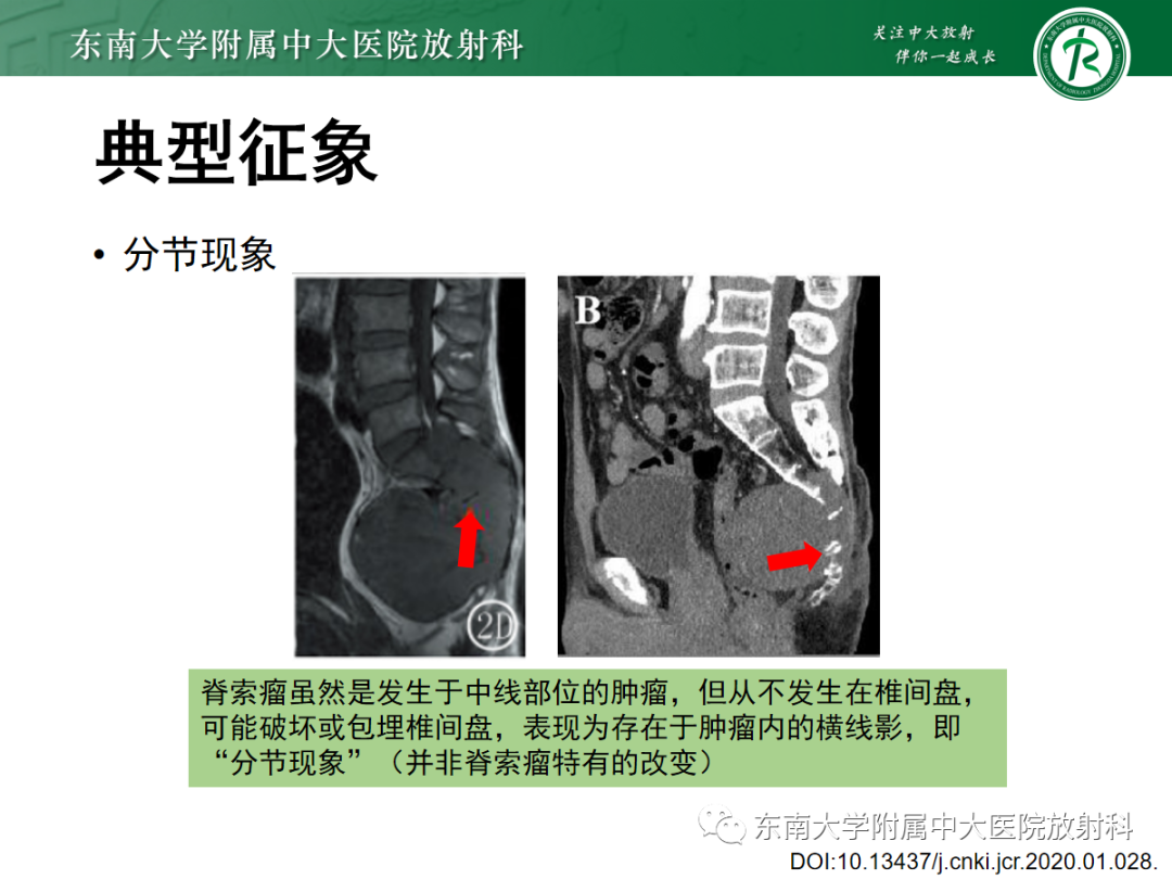 影像PPT - 【PPT】骶尾部脊索瘤-16