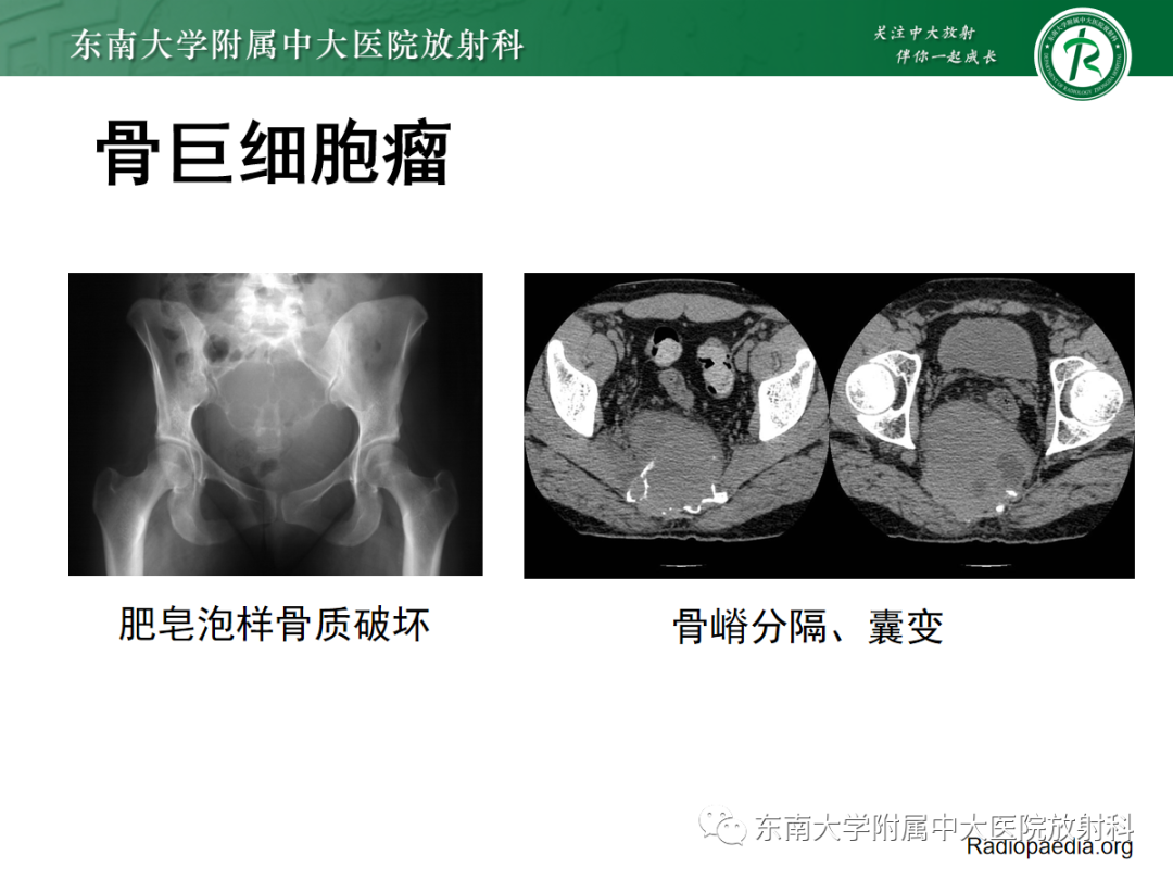 影像PPT - 【PPT】骶尾部脊索瘤-18
