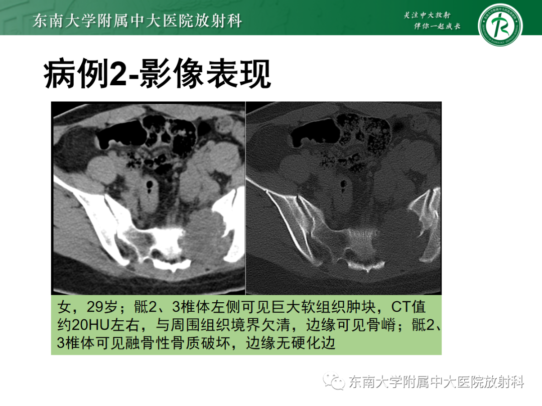 影像PPT - 【PPT】骶尾部脊索瘤-19