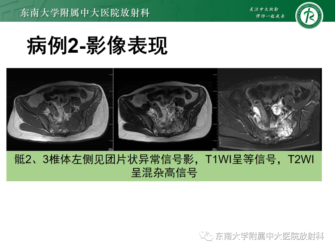 影像PPT - 【PPT】骶尾部脊索瘤-20