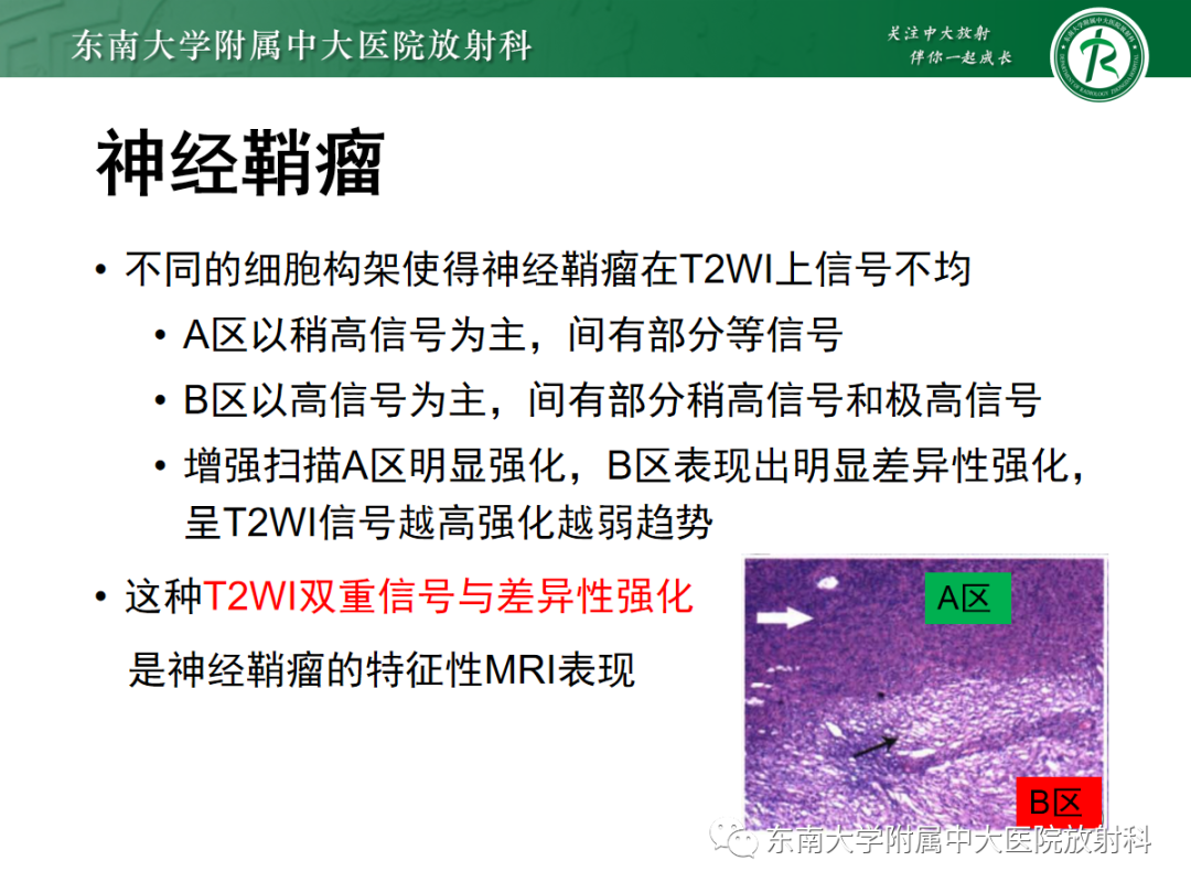 影像PPT - 【PPT】骶尾部脊索瘤-23