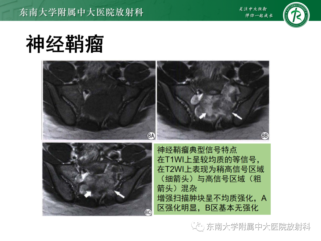 影像PPT - 【PPT】骶尾部脊索瘤-24
