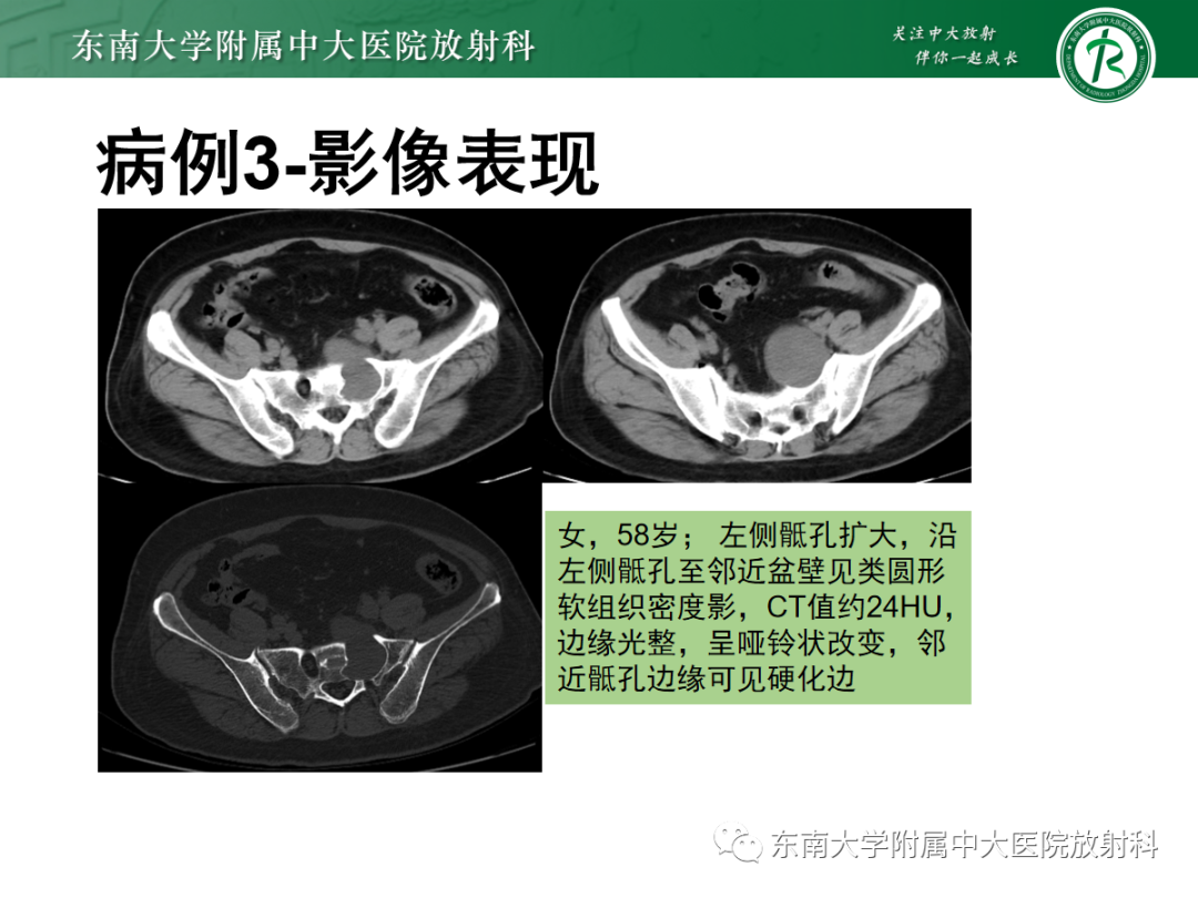 影像PPT - 【PPT】骶尾部脊索瘤-25