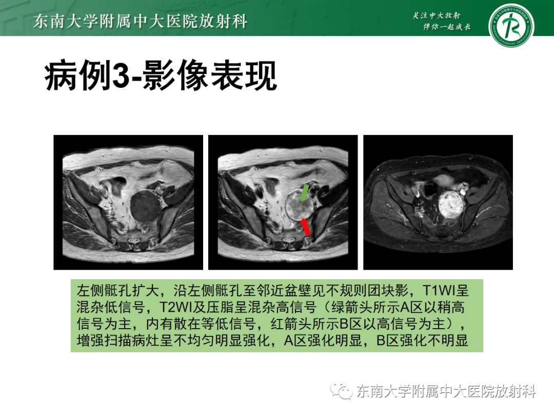 影像PPT - 【PPT】骶尾部脊索瘤-26