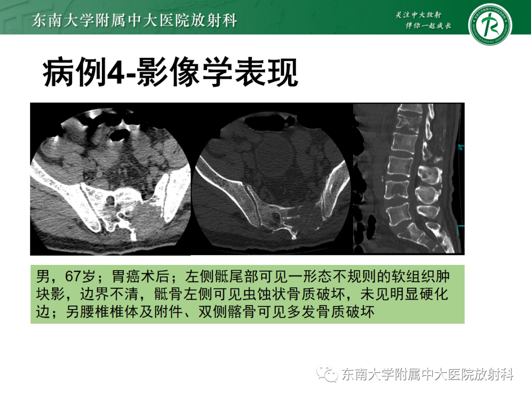 影像PPT - 【PPT】骶尾部脊索瘤-31