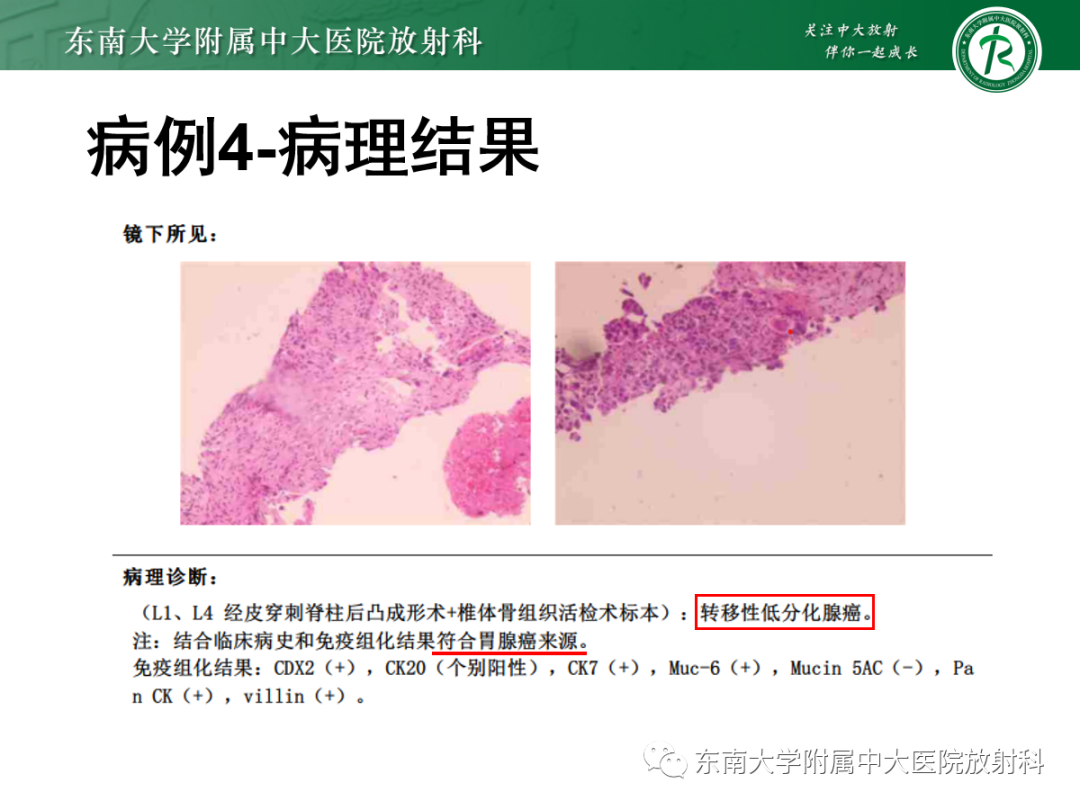 影像PPT - 【PPT】骶尾部脊索瘤-32
