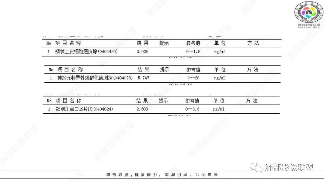 影像PPT - 【病例】肺淋巴上皮瘤样癌1例CT影像-4