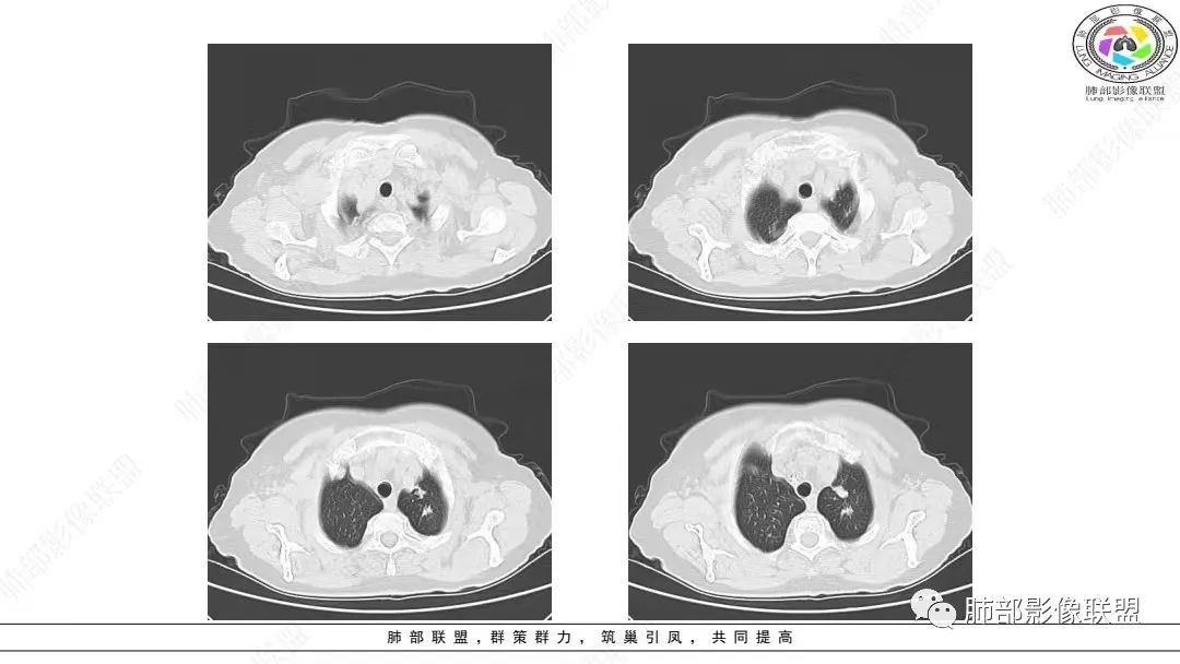 影像PPT - 【病例】肺淋巴上皮瘤样癌1例CT影像-5