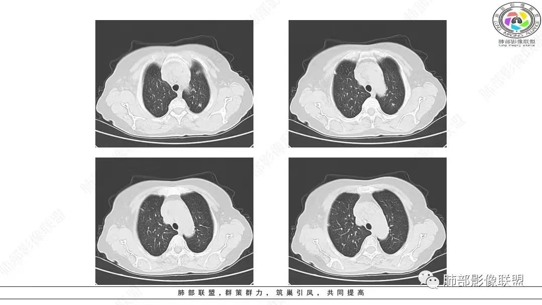 影像PPT - 【病例】肺淋巴上皮瘤样癌1例CT影像-6