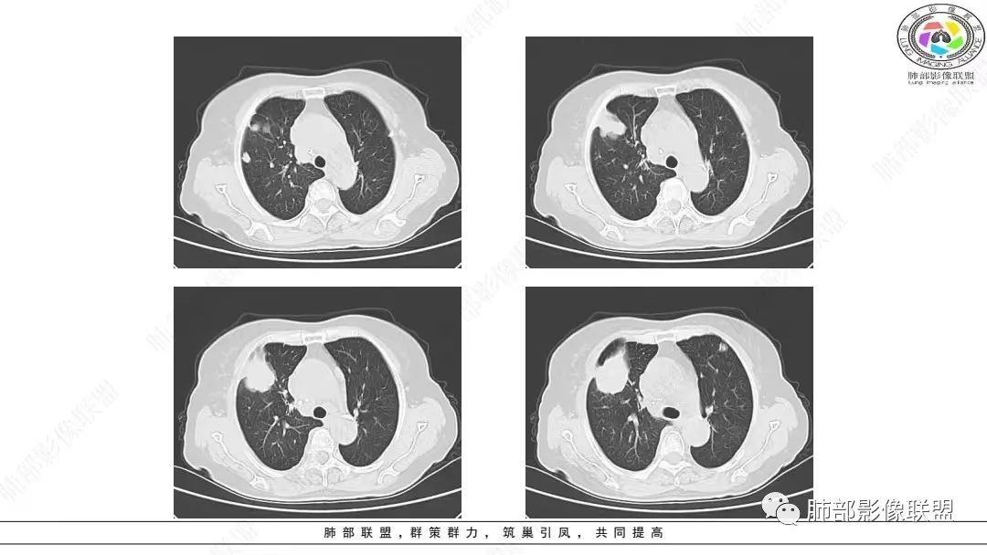 影像PPT - 【病例】肺淋巴上皮瘤样癌1例CT影像-7