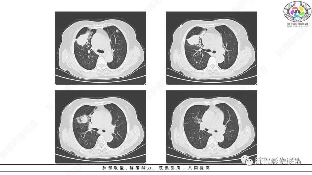 影像PPT - 【病例】肺淋巴上皮瘤样癌1例CT影像-8