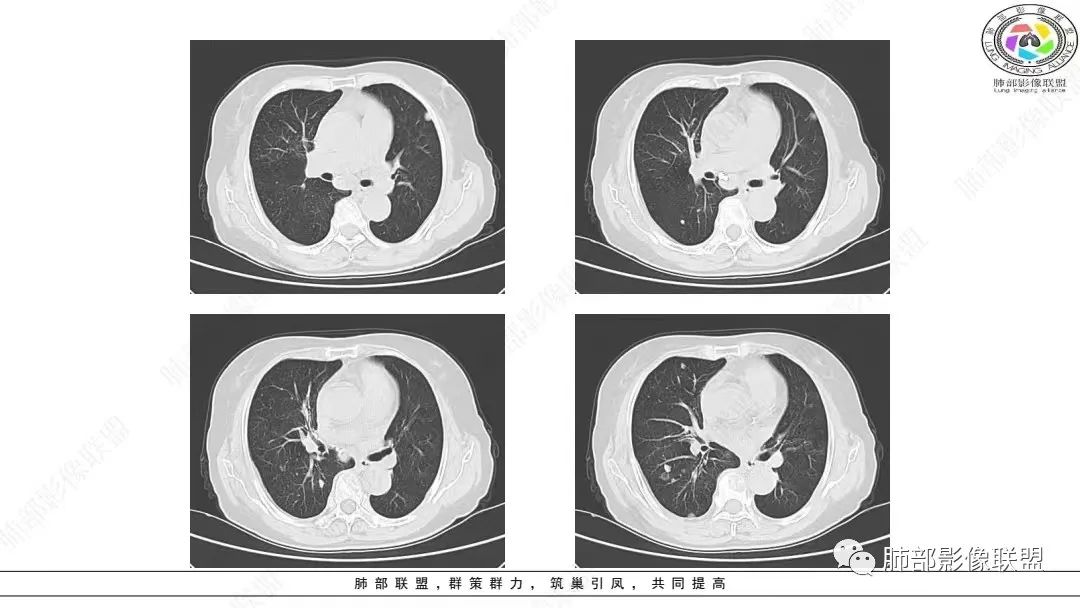 影像PPT - 【病例】肺淋巴上皮瘤样癌1例CT影像-9