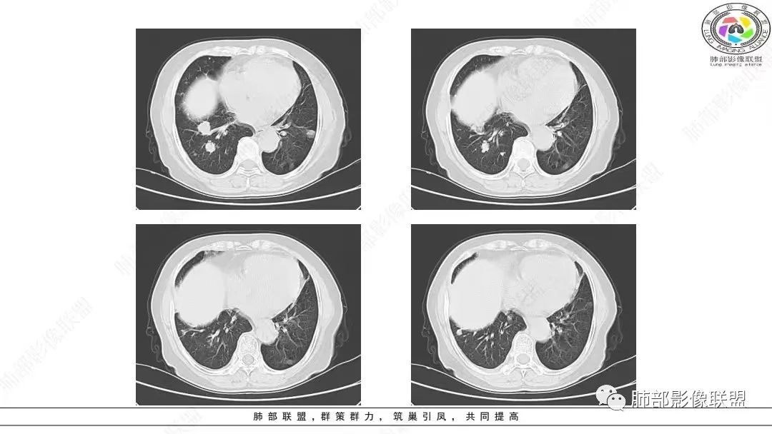 影像PPT - 【病例】肺淋巴上皮瘤样癌1例CT影像-11