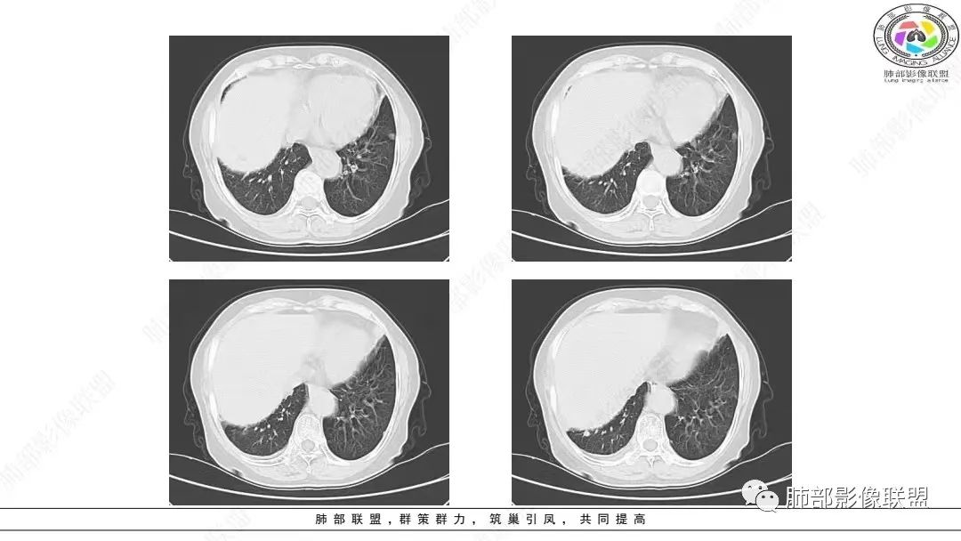 影像PPT - 【病例】肺淋巴上皮瘤样癌1例CT影像-12