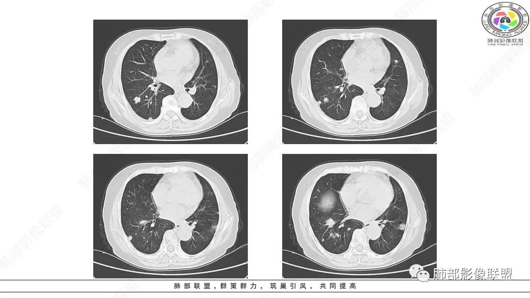 影像PPT - 【病例】肺淋巴上皮瘤样癌1例CT影像-10