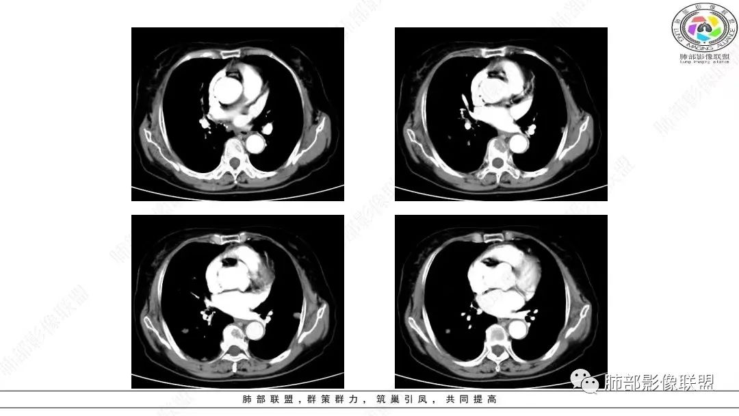 影像PPT - 【病例】肺淋巴上皮瘤样癌1例CT影像-26